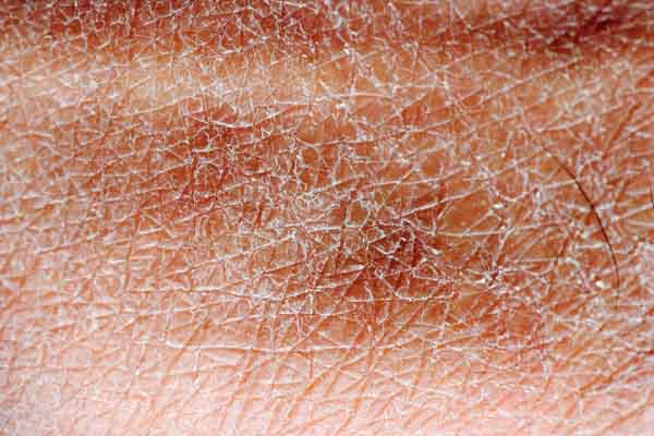 image of excessively dry skin due to poor air quality from hvac system