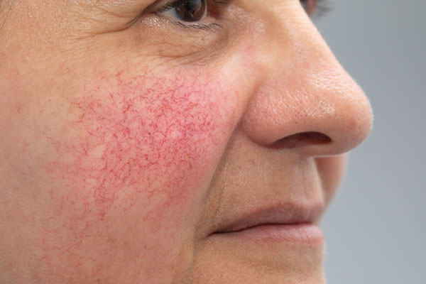 image of rosacea and hvac and skin issues