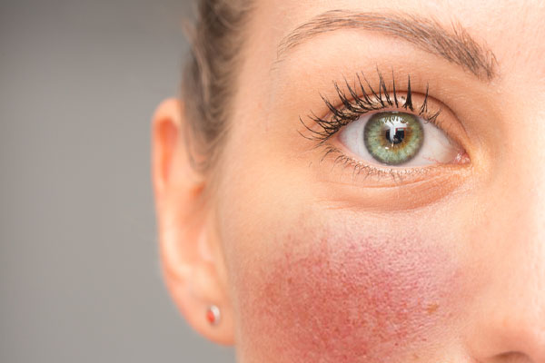 image of rosacea caused by poor indoor air quality